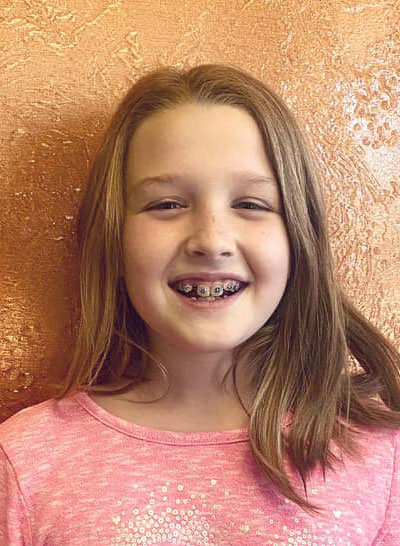 A young girl showing her teeth after a Braces treatment.