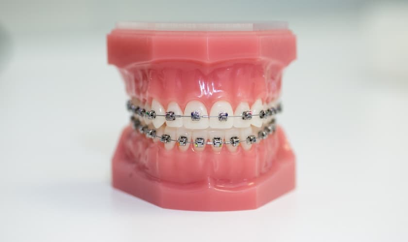 Straighten Teeth Discreetly with Lingual Braces in Phoenix