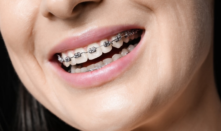 Featured image for “Dealing with Discomfort: Tips for Managing Braces Pain”