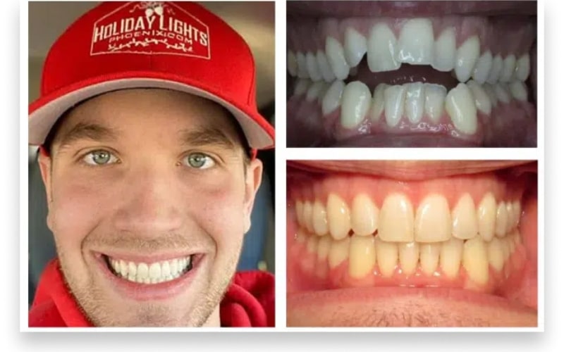 Featured image for “Ditch the Braces, Get a Smile: How Invisalign Works”
