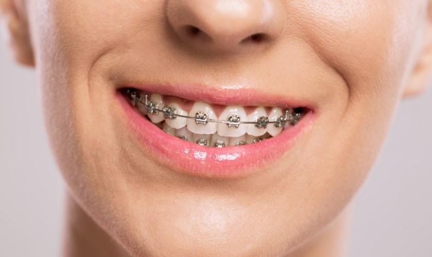Featured image for “The Path to a Perfect Smile Starts Here: Braces for Adults & Teens”